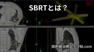 SBRT（体幹部定位放射線治療）とは？効果・適応・副作用を専門医が解説